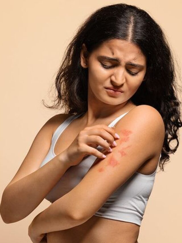 आप भी हैं घमौरियों से परेशान, अपनाएं ये घरेलू नुस्खे
